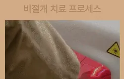 통합/랜딩/발톱/문제성발톱/1만원/250619(르샤인수정)